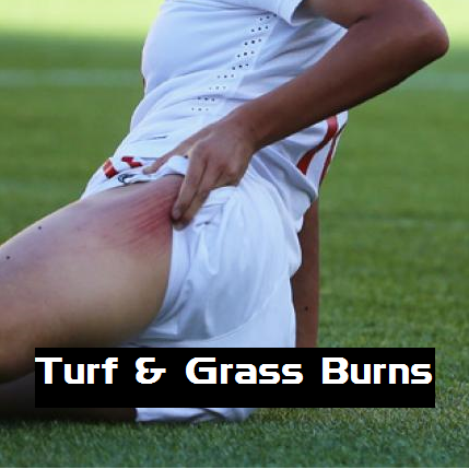 Goalkeeper Grass or Turf Burns